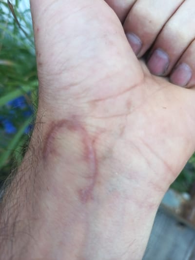 The image is a close-up, medium-shot photograph of a person's wrist and hand. The skin on the wrist shows a faint, circular mark, possibly a scar or imprint, with a reddish-purple hue. The wrist is covered in light hair. The person's fingers are visible in the upper right portion of the frame, with fingernails that appear to have a purplish tint and some dirt under them. The background is out of focus, showing greenery, possibly plants or grass, with hints of blue in the distance. The lighting suggests it is daytime, with natural light illuminating the scene. The overall tone is neutral, focusing on the detail of the wrist and hand. There is no visible text in the image. The location context provided is Durlești, Moldova, but this cannot be visually confirmed from the image itself.