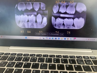 The image presents a forensic close-up of a Samsung laptop, displaying digital dental radiographs on its screen within an indoor environment. The screen prominently features two sets of dental periapical X-rays. The left X-ray shows images of five teeth, specifically numbered 55, 54, 53 in the upper region and 85, 84, 83 in the lower region. The right X-ray displays five teeth, numbered 63, 64, 65 in the upper region and 74, 75 in the lower region, with a distinct horizontal radio-opaque object positioned between the upper and lower dental structures. The software interface on the screen includes navigation and action buttons labeled "Voltar" (Back), "Baixar" (Download), and "Ferramentas" (Tools), all in Portuguese. The lower portion of the screen reveals a Windows 11 taskbar with a search bar labeled "Pesquisar" (Search) and various application icons. The laptop's keyboard, in a light gray color with black keys, is partially visible in the foreground, showing a standard QWERTY layout with some visible wear, particularly on keys such as 'K' and '0'. No individuals are present in the image. The scene is consistent with a professional dental or medical office. The specific location within the city of Lauro de Freitas, Brazil, is not visually verifiable from the image content.