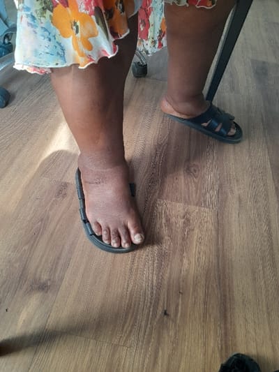 The image depicts the lower extremities of an individual situated indoors in the city of Ikota, Nigeria. The subject's dark-toned skin is visible from mid-calf downwards. They are wearing a light-colored, floral-patterned garment featuring white, orange, and light blue hues. The left ankle and foot exhibit visible swelling, with the foot partially displaced from a black slide sandal. The right foot is fully enclosed within a black, multi-strap sandal. Toenails on the visible left foot appear unpolished. The floor beneath the subject is composed of light brown, wood-effect laminate planks. Fragments of black furniture, including a caster wheel and a metal frame, are partially visible in the foreground and midground.