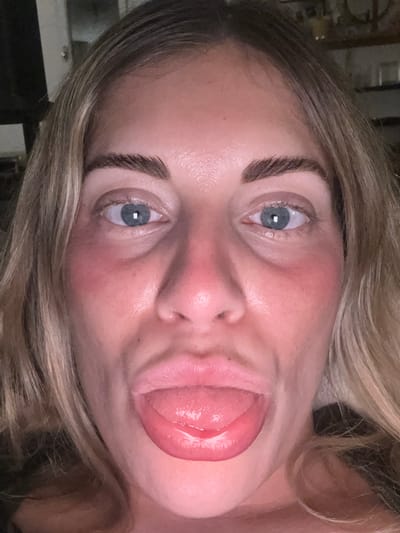 A close-up, eye-level photograph captures a Caucasian adult female. She has long blonde hair visible on both sides of her face, blue eyes, and dark, well-defined eyebrows. Her face presents with a flushed or reddened appearance, particularly across the cheeks and nose, and some redness is also evident around her eyes. Her mouth is open, with her tongue extended forward and slightly downwards, appearing moist. She is looking directly at the camera. The background is dark and significantly out of focus, indicating an indoor setting with limited ambient light. Indistinct, blurred shapes, possibly furniture or decorative items, are faintly visible in the upper right portion of the background. This scene is located in the city of Rueil-Malmaison, France.
