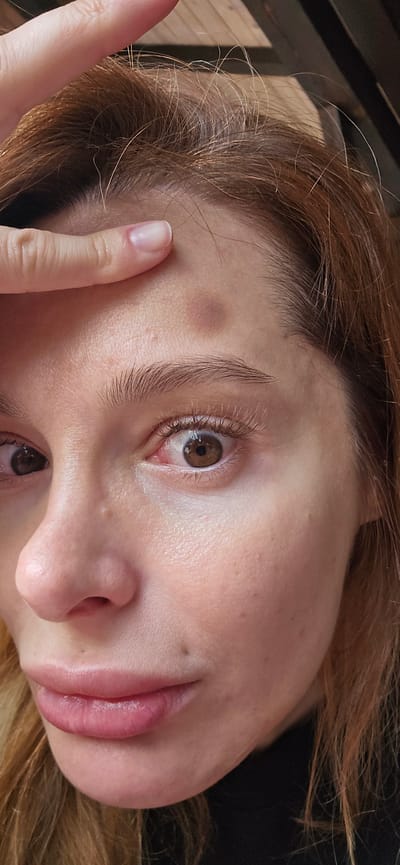 Close-up image of a light-skinned person's face, tilted to the side. The person has brown hair and brown eyes. There is a noticeable bruise on the forehead near the eyebrow. A finger is touching the forehead near the bruise. The person is indoors. Kopito, Montenegro is not visible in the image.