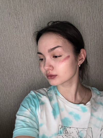 The image displays a female individual situated in Bayronovka, Russia. The subject has dark hair and light complexion. A distinct reddish-purple linear mark is present on her left cheekbone, accompanied by a fainter reddish discoloration below her left eye and around the nasal and oral regions. She is wearing a white t-shirt with a blue tie-dye pattern, a thin chain necklace adorned with small beads, and two earrings in her left ear: a small stud in the lobe and a metallic cuff on the upper cartilage. Her gaze is directed downwards and slightly to her left. The background features a textured wall with vertical linear patterns in a neutral grey tone. The scene is illuminated by indoor lighting.