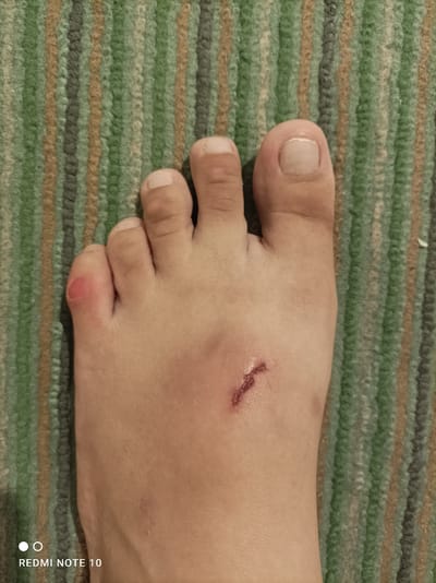 A close-up, top-down view shows a human foot positioned on a carpet with vertical stripes in shades of green, brown, and gray. The foot exhibits several notable features. On the left side of the image, the pinky toe is visible, with a reddish, slightly raised area on its tip, potentially indicating a blister or abrasion. Further towards the center of the foot, there is a shallow cut, appearing as a reddish-brown line with some dried blood or scab. The skin on the foot is fair-toned. The background carpet's texture is fuzzy and woven. No other individuals or objects are present in the immediate vicinity. The image is not set in any discernible urban or natural environment.