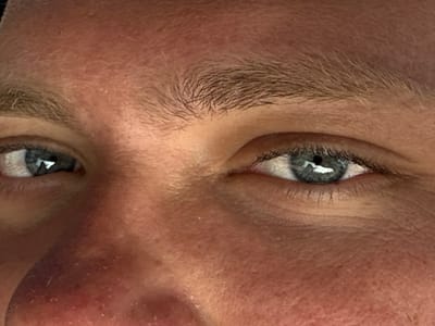 A forensic close-up image displays the upper facial features of an individual, stated to be located in Bhagatwadi, India. The frame is dominated by two open eyes with blue-grey irises, visible pupils, and distinct specular reflections from an overhead light source. Both eyes are framed by light brown eyebrows and eyelashes. The skin exhibits a fair complexion with a reddish hue, revealing visible pores and fine lines, particularly around the periorbital area. The bridge and upper portion of the nose are visible centrally at the bottom of the frame, also displaying a reddish tone. No actions, interactions, or further environmental details are discernible within the cropped frame.