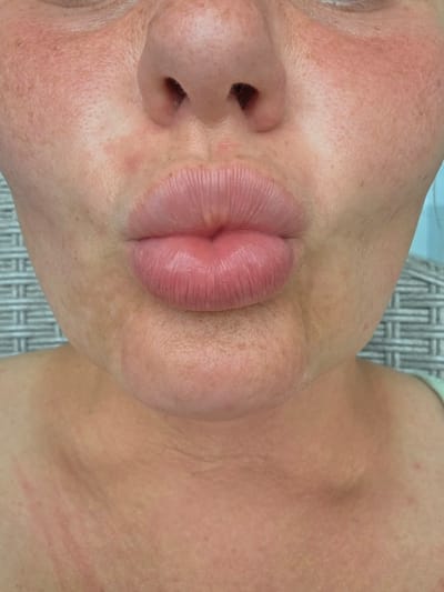 The image is a close-up, front-facing shot of a person's mouth and lower face. The person is puckering their lips as if for a kiss. The skin is fair with visible pores and freckles, particularly on the cheeks. There are areas of redness on the cheeks and neck, with some linear markings on the neck which could be scratches or a rash. The person is wearing a light-colored, possibly striped, shirt. The background is blurred, but appears to be a woven textured surface. No specific location within Jiyang District, China is visible or discernible from the image.
