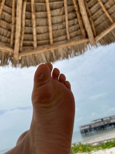 The image displays a close-up, upward-angled view of the sole of a human left foot, positioned centrally in the foreground. The foot exhibits a yellowish-pink blister on the ball of the big toe and a distinct reddish circular mark on the central sole below the toes. Above the foot, the underside of a circular thatched roof structure, composed of natural woven materials and supported by wooden beams, occupies the upper third of the frame. Beyond the foot and the thatched structure, a cloudy sky is visible. In the distant background, a blurred coastal environment is present, featuring calm ocean water, a strip of sandy beach with sparse green foliage, and a wooden pier extending into the water. This scene is situated on a beach in Zanzibar, Tanzania.