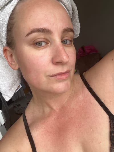 The media file is a close-up, vertically oriented photograph of a person's face and upper chest. The subject, appearing to be a woman, has a light complexion and is looking towards the camera with a neutral expression. She has blue-green eyes, defined eyebrows, and her hair is partially covered by a white towel. Water droplets are visible on her skin, suggesting she may have recently showered or washed her face.
Her upper chest and neck area are noticeably flushed red and appear irritated, with small bumps or blemishes visible. She is wearing a black bra with a thin strap that crosses her chest. The background is dark and indistinct, with some hints of objects and textures that are out of focus.
There is no visible text in the image. The lighting suggests it could be daytime or artificial lighting in an indoor setting. The overall impression is one of post-treatment skin care or a reaction to something.