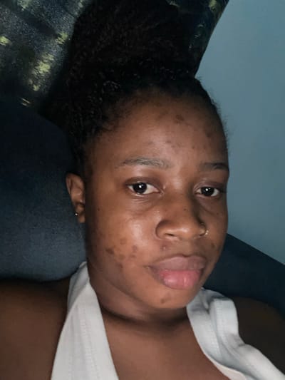 A woman with dark skin and dark, curly hair lies on a dark gray surface. She wears a white top. Her face features brown eyes, a nose ring, and light pink lips. Uneven pigmentation is visible on her forehead, cheeks, and around her mouth. The background consists of a dark green and black patterned material on the left and a blue wall above.