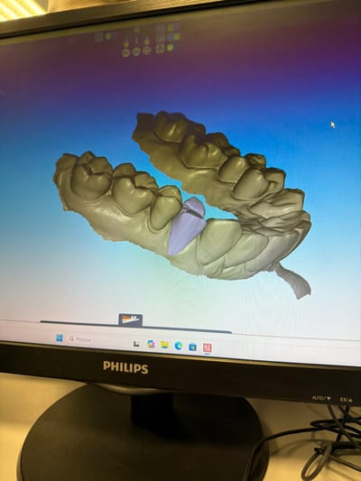 The image displays a Philips computer monitor situated on a desk in Gandra, Portugal. The monitor's screen presents a dental CAD software interface featuring a 3D digital model of upper and lower dental arches. These arches are rendered in a beige color, positioned against a blue gradient background that transitions from dark blue at the top to a lighter blue. A specific tooth preparation on the lower arch is highlighted in a distinct light purple hue. The software's tool icons are visible across the top edge of the display, and a mouse cursor is present in the upper right quadrant. The Windows 11 taskbar is visible at the bottom of the screen, featuring the search prompt "Procurar" (Portuguese for "Search") alongside several application icons. Black electrical wires are visible behind the monitor's stand. No individuals are depicted in the scene.