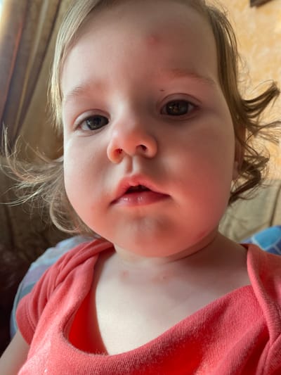 A close-up, head-on shot shows a toddler with fair hair and fair skin. The toddler is wearing a coral-colored shirt. The background is blurred and appears to be an indoor setting with patterned curtains. The toddler's face is the primary focus, with their eyes, nose, and mouth visible. There are a few small red marks on the toddler's forehead and chest. The lighting suggests it is daytime, with a warm glow.