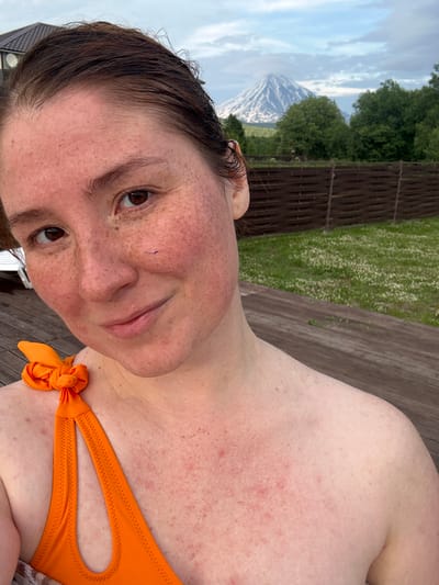 A woman with fair skin and freckles is taking a selfie outdoors. She is wearing an orange bikini top. Her hair is dark brown and pulled back. Her skin appears red and slightly irritated. In the background, there is a wooden fence, green grass with white flowers, trees, and a snow-capped mountain under a cloudy sky. The scene appears to be in a rural or natural setting.