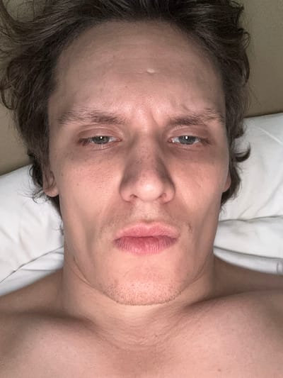 The image is a close-up, overhead shot of a person's face as they lie on a white pillow. The person appears to be male with light skin and tousled brown hair. The lighting is warm, casting shadows on the face and highlighting the texture of the skin, including pores and a small mole on the forehead. The person's eyes are open and looking directly at the camera, with a slightly furrowed brow. The lips are parted, revealing a bit of the mouth. A light stubble is visible on the chin and jawline. The background consists of the white pillow and what appears to be a duvet or blanket. The image does not contain any elements that would suggest a specific location in San Francisco, United States of America.
