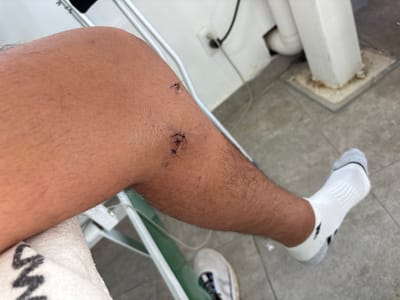 An image shows a person's lower leg with a white sock and an ankle that has been stitched in two different places. The stitches appear to be freshly done, with the suture material still visible. The background includes a tiled floor, part of a white metal frame, and a glimpse of another shoe. The overall setting suggests a medical or clinical environment.