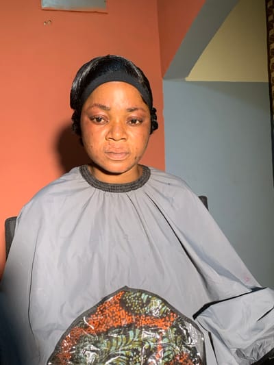 An adult female is depicted seated indoors in what is identified as Garaku, Nigeria. She faces the camera directly with a neutral expression. Her dark hair is styled back with a black headband, and ringlets are visible on the sides. Her face exhibits redness and puffiness, particularly around the eyes and upper cheeks, along with minor skin discolorations. She wears a grey, smock-style cape with a dark ribbed collar, covering her torso and arms. A clear plastic overlay on the lower right of the cape covers a section of patterned fabric displaying shades of orange, green, and black. The background consists of a salmon-orange wall directly behind her, transitioning to a light blue-grey wall section to her right (viewer's left), and a sliver of light yellow-beige wall above that. Two small dark marks are visible on the orange wall behind her head.