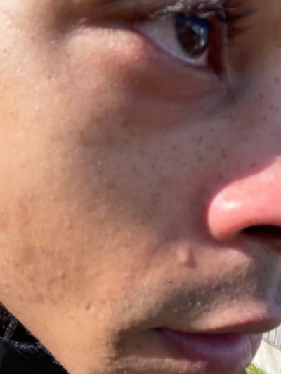 A forensic close-up image captures the right side of a human face in Montigny-le-Bretonneux, France. The subject's skin presents a light brown complexion with numerous freckles and visible pores. The right eye is open, revealing a dark iris and dark eyelashes. The right side of the nose is partially visible, exhibiting a reddish tone under direct illumination. Stubble is evident on the upper lip and lower facial area. A single, clear liquid droplet is positioned on the right cheek, inferior to the nose. A dark, textured fabric, likely an article of clothing, is partially visible in the lower-left corner of the frame. The scene is illuminated by direct sunlight, and the out-of-focus background suggests an outdoor environment with a light-colored structure and green vegetation.