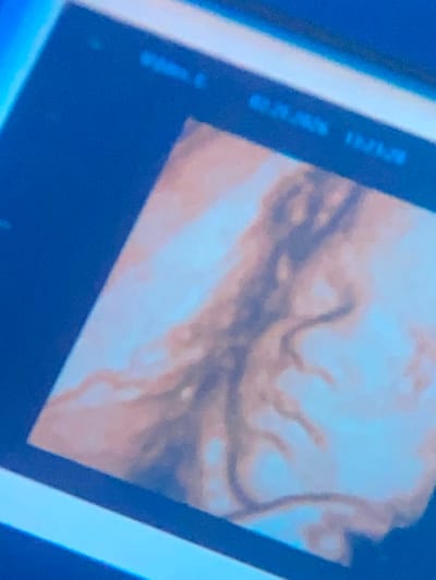 A photograph captures a dimly lit screen displaying what appears to be a medical scan or a highly detailed biological image. The main subject within the screen is a complex, undulating pattern of dark, thick lines resembling internal anatomical structures like blood vessels, neural networks, or brain folds. These structures are set against a lighter, ethereal background composed of light blue, pale orange, and pinkish hues, creating a somewhat translucent effect.
The screen itself is visible with dark blue borders, and there are bright white sections or reflections on its right side. The photograph is taken at an angle, indicating the screen is a physical monitor being viewed. The overall lighting of the surrounding environment is dim, with a noticeable blue glow originating from the lower left corner, casting reflections on the screen's surface.
In the upper left corner of the displayed image, faint, light blue, pixelated text is discernible. It appears to include "01:21:00" and another sequence, "132100," possibly indicating a timestamp or a specific identifier for the scan. The scene suggests an activity of viewing or analyzing medical or scientific data. No specific details within the image directly indicate the location is Gosa, Nigeria.