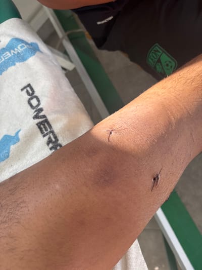 The image shows a close-up view of a person's arm, likely a forearm or upper arm, positioned diagonally across the frame from bottom left to top right. The skin is of a medium tone, and there is visible arm hair. Two distinct stitches are present on the arm. One stitch is located closer to the viewer, appearing as a dark thread piercing the skin in two points with its ends extending upwards in a slightly curved fashion. The second stitch is further up the arm, also visible as a dark thread, with its ends extending horizontally. Both stitches appear to be simple interrupted sutures. There is a slight discoloration or bruising around the stitches, indicating a recent injury or medical procedure.
In the background, on the left side of the image, a dark-colored fabric is visible, possibly part of a t-shirt or athletic wear. On this fabric, there is a green logo or emblem. The logo appears to be a stylized crest or shield shape, containing what looks like a soccer ball at the top and text below it, possibly "LEON" or a similar word, though not fully clear.
Beneath the arm, a white towel or cloth is visible. Bold blue lettering on the towel clearly spells out "POWERADE". Below this text, there is a blue design resembling splashes or abstract shapes. The overall lighting suggests bright conditions, possibly sunlight, creating clear highlights and shadows on the arm, indicating it might be daytime and potentially outdoors or near a window. A faint white and green structure, possibly a railing or part of a piece of equipment, is also visible in the background, further suggesting an outdoor or sports facility setting.