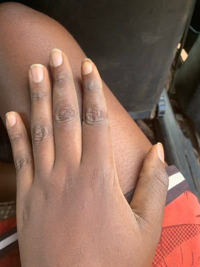 This image, captured in Gidan Jatau, Nigeria, depicts a close-up view of a left human hand, palm-down, resting on a bare thigh. Both the hand and thigh exhibit a dark skin tone. The fingers are slightly flexed, revealing natural, unpolished fingernails, some of which show minor subungual discoloration. The skin on the knuckles and finger joints presents visible creases and a somewhat dry texture. A small portion of an orange garment, featuring white and brown stripes, is visible at the bottom right. The background is dark, out-of-focus, and indistinct, consistent with an interior environment, possibly within a vehicle.