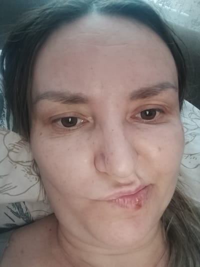 A close-up, front-facing selfie of a woman with dark hair and fair skin, lying down. Her head is tilted slightly to the right, and her gaze is directed towards the camera. She has visible forehead wrinkles and dark eyebrows. Her left eye is fully visible, while her right eye is partially obscured by the angle. The woman has a visible lesion on her upper lip, towards the right side, appearing red and slightly scabbed. Her lips are parted. Her neck and upper chest are also visible. She is resting on a pillow with a floral pattern. The image's lighting is soft and diffused, suggesting an indoor setting. The overall impression is a candid, unposed shot. There is no discernible city of Yarovoye, Russia present in the image.