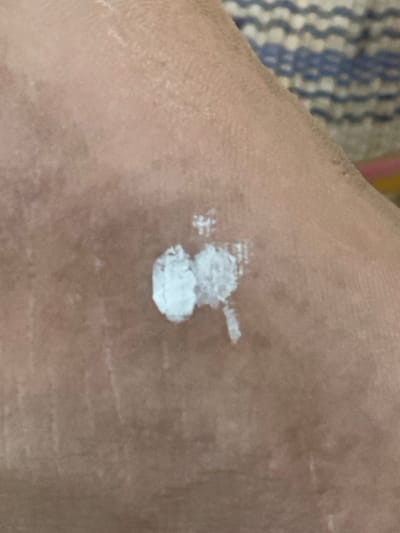A close-up image depicts a section of human skin, exhibiting a light to medium brown complexion with visible pores and fine lines, located in Mns Asan, Indonesia. Several distinct, irregular white deposits are present on the skin surface. Two primary deposits, approximately 5-7mm in greatest dimension, are centrally located, appearing as off-white, opaque, semi-solid or dried pasty substances. Smaller, scattered white specks and streaks radiate from these main deposits. The skin also shows subtle, lighter linear markings in the upper left area. The background in the upper right is out of focus, revealing a textile pattern with horizontal stripes in shades of light blue, white, and darker blue or brown. The scene is evenly lit.