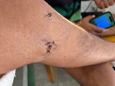 The image displays a close-up view of a human limb, likely an arm or a leg bent at a joint, revealing multiple sets of sutures. The skin tone is medium, and there is visible hair on the limb.
The primary focus is on two distinct areas where sutures are present. The most prominent set of sutures is located towards the upper part of the image, possibly on or near an elbow or knee joint, given the slight crease in the skin. Here, several black threads are visible, forming a star-like or crisscross pattern over a small, reddish, and slightly raised area, indicating a recent wound or incision. Faint, dark blue or purple lines, resembling marker markings often used in medical procedures, are visible on the skin around these sutures.
Further down the limb, towards the lower right, another smaller set of sutures is visible. This one appears to consist of two black threads, securing a smaller incision or puncture wound. The skin around this smaller set of sutures also shows some discoloration.
In the lower left portion of the image, a hand with medium skin tone is partially visible, holding a dark-colored smartphone. The phone's screen is illuminated with a bright blue light, displaying blurred, abstract blue shapes, possibly a drawing or an application interface. Below the hand, a green and black patterned fabric, likely clothing, is discernible. To the upper right, a section of white, textured material, possibly a towel or bandage, is partially wrapped around or resting on the limb. The background is mostly out of focus but suggests an indoor setting with subtle hints of furniture or other objects.
The overall scene depicts a limb recovering from a medical procedure that required stitches.
