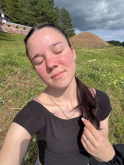 In Pozdyshki, Russia, on a sunny day, a young woman with her eyes closed sits on grass. Her face exhibits redness and some acne. She wears a black t-shirt and is adorned with silver necklaces and rings. In the background, a large pile of gravel sits near a dense line of trees, with a building and more trees visible on a hill to the left. The sky is partly cloudy.