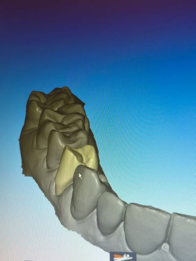 The image displays a digital 3D rendering of a human upper dental arch, consisting of molars and premolars, shown on a computer screen. The teeth models are primarily a light grayish-tan color, with one premolar distinctly highlighted in a yellowish-tan hue. A white arrow-shaped computer cursor points to the buccal surface of the highlighted yellowish-tan premolar. The background behind the dental model is a digital gradient transitioning from a darker blue at the top left to a lighter blue towards the bottom right. Vertical pixel lines are visible across the screen capture. This digital scene is presented on a screen, located in the city of Gandra, Portugal.