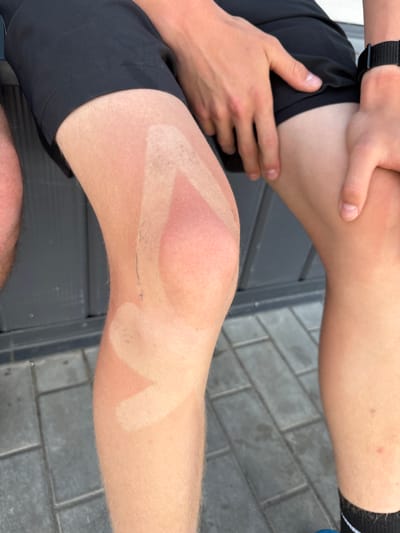 The image shows a person sitting with their right knee exposed, displaying a sunburn pattern. The sunburn is concentrated around the knee and lower thigh, creating distinct lines that suggest the person was wearing shorts and possibly knee pads. Another person's arm and hand are visible, resting on the upper thigh of the person with the sunburn. The background consists of gray brick pavement and dark gray horizontal planks. There is no indication of Казань, Russia in this image.