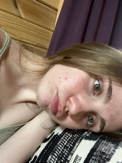 The image shows a close-up, head-and-shoulders view of a young person with light brown hair and green eyes, lying down and looking towards the camera. The person appears to be indoors, with wooden paneling visible in the background, suggesting a rustic or cabin-like setting. A dark purple curtain is also visible in the upper right portion of the frame. The person is wearing a light-colored tank top. The skin has some redness and blemishes, particularly on the cheeks. The person's head is resting on a patterned surface, possibly a pillow or blanket, which is black and white with a geometric design. The lighting is soft, and the image is taken from a slightly upward angle, emphasizing the person's face. There is no indication of the specific location within the city of Ashkadar, Russia, as the image contains no discernible landmarks or contextual elements that would place it in that city.
