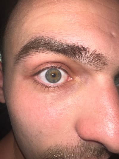 A close-up image features a person's eye, eyebrow, nose, and part of the surrounding facial skin. The eye is hazel or greenish-gray, with visible eyelashes. The eyebrow is thick and dark brown. The skin appears fair, with visible pores and some minor skin imperfections such as small bumps and blemishes. The image is taken at a close range, providing significant detail of the individual's face. The location of Strymoniko Municipal Unit, Greece, cannot be determined from the image.