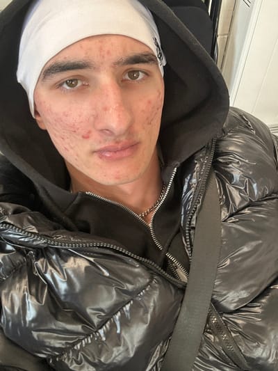 A young male individual with light-to-medium skin tone directly faces the camera. He has dark eyebrows and brown eyes. His face exhibits numerous red blemishes and active acne across the forehead, cheeks, and chin. His lips appear full, with some visible texture on the lower lip. He wears a white head covering, possibly a durag or headband, with a faint dark emblem visible on the right side. Beneath this, his dark hair is not visible. He is dressed in multiple layers, including a dark hooded garment underneath a shiny black puffer jacket that is partially zipped. A thin silver-colored chain is visible around his neck. A black fabric strap, possibly from a bag or seatbelt, crosses diagonally over his right shoulder and chest. The background is out of focus, indicating an indoor setting with light-colored walls or surfaces on the right and darker, possibly structural, elements behind the individual's right shoulder. No specific features in the image indicate a location within Dorchester, United Kingdom.