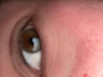 A close-up, blurry image shows a brown eye with a prominent white reflection. The surrounding skin appears red and inflamed, possibly irritated or showing signs of a rash. The image quality is low, making precise identification of skin conditions difficult.