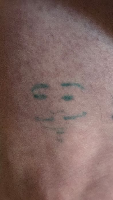 A close-up image depicts a segment of human skin, exhibiting a light to medium brown complexion with visible pores and fine hair follicles. Centered on the skin is a faded, teal-colored tattoo. The tattoo forms a stylized, abstract face or emoticon, consisting of two short, horizontally curved lines representing eyebrows, two small, somewhat irregular ovals or dots below them indicating eyes, and two longer, curved lines further below suggesting a mouth. A singular, short vertical line is present beneath the mouth. No environmental context, background, or other objects are discernible to determine the specific location within the city of Lompoc, United States; the image exclusively focuses on the skin and the tattoo.