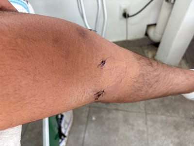 A close-up shot captures a light-skinned arm with sparse hair, featuring two distinct surgical wounds closed with sutures. The larger wound at the upper arm appears to have several stitches, while a smaller wound lies closer to the center. Fine red lines surround the sutures. The arm rests against a backdrop of a white sink and a tiled floor. A sneaker can be seen in the periphery.