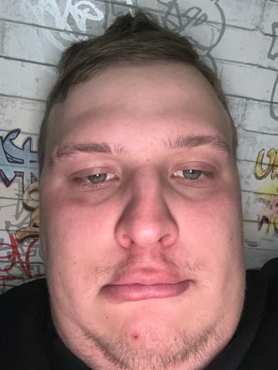 The image presents a head-and-shoulders frontal portrait of an adult male in Matveevskoe, Russia. The subject has light brown hair, green-blue eyes with heavy eyelids, and light stubble on his chin and upper lip. A single red lesion is visible on the chin. His mouth is closed, forming a slight pout. He wears a dark-colored garment, partially visible at the bottom of the frame. The background is a light-colored wall featuring multi-colored graffiti-style lettering and designs, indicating a textured surface. The subject's gaze is directed forward.