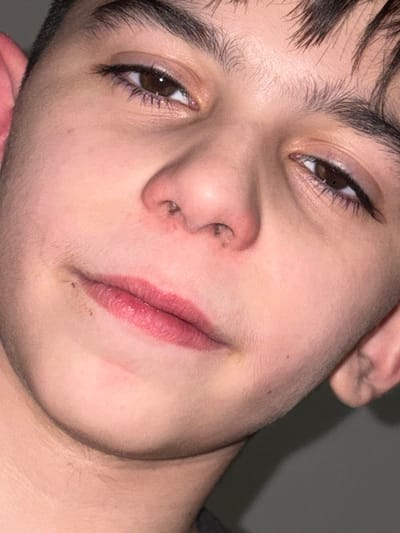 The image presents a tightly cropped, slightly upward-angled, close-up portrait of a single individual's face, likely a male adolescent, with fair skin and dark hair. The subject is looking directly towards the camera.
**People:** One individual is depicted, characterized by dark brown eyes with discernible eyelashes, distinct dark eyebrows, and short, dark hair visible across the forehead. Fine, nascent hair growth (vellus hair) is present on the upper lip, cheeks, and chin area.
**Subjects:** The primary subject is the individual's face, encompassing features from the forehead down to the upper neck.
**Objects:** No objects are present within the frame beyond the individual's facial anatomy.
**Actions/Interactions:** The individual maintains a direct, level gaze towards the camera lens. No other action or interaction is evident.
**Environment:** The background is uniformly dark grey and out of focus, suggesting an indoor setting with a plain wall or backdrop. The lighting appears direct, illuminating the facial features without casting harsh shadows.
Specific observations regarding the individual's features include:
- **Eyes:** Dark brown irises are present, with white sclera and eyelids that exhibit a light tone, showing a subtle sheen.
- **Nose:** The nasal bridge and the immediate perimeter of the nostrils display multiple small, dark pigmented spots or blemishes.
- **Mouth:** The lips are full and naturally reddish-pink, with minor surface irregularities or slight chapping visible on the lower lip. Several small, dark, granular spots are noted on the skin immediately superior to the left labial commissure (corner of the mouth).
- **Skin:** The overall complexion is light-toned, with areas of faint erythema (redness) around the nasal region and on the chin. A subtle yellowish ecchymosis (bruise-like discoloration) is visible inferior to the right malar prominence (cheekbone), and a similar, though less distinct, mark is observed on the left lateral facial region near the ear.
The image contains no visual elements that provide information to determine a specific geographical location, including the city of Saint-Étienne, France.