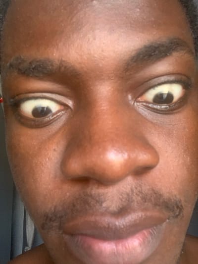 This image presents a close-up, frontal view of an adult male's face, situated in the city of Oluke, Nigeria. The subject exhibits a dark skin complexion, dark eyebrows, and sparse, dark facial hair forming a mustache and light growth around the chin. Both eyes are wide open, pupils dark and centrally positioned, with the surrounding sclera displaying a distinct yellowish tint. The eyes are angled downwards and slightly inwards, directed toward the viewer. The mouth is closed. The immediate background is out of focus and indistinct, composed of blurred dark tones, with a faint vertical dark object visible on the left side of the frame.