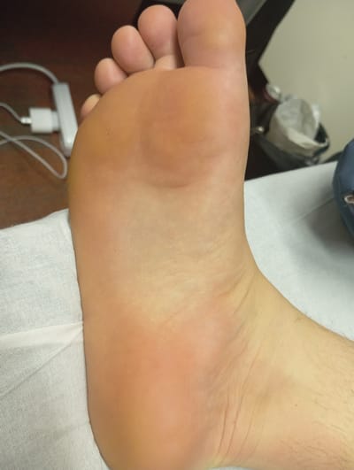 The image shows a close-up view of the sole of a human foot. The foot is resting on a white textured fabric, possibly a medical sheet. The skin of the sole is a light tan color with visible texture and creases. The toes are visible at the top of the image, and the heel is towards the bottom. The background is out of focus, but shows a wooden surface on the left, where a white charging cable and adapter are partially visible. On the right, there is a blurry grey and white object, and a dark blue object. The scene is an indoor environment. The location in Anderlecht, Belgium is not discernable from the visual information in the image.