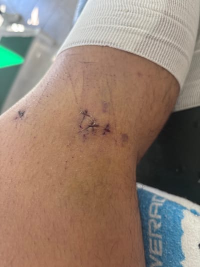 An arm with surgical sutures, bruising, and visible skin markings. The arm is bandaged near the wrist. There are two sets of stitches visible. The larger wound site has three stitches forming a triangular shape. A smaller set of stitches is visible toward the bottom of the frame. Hair follicles are present on the arm. A blue and white towel is visible near the elbow. A green object can be seen in the lower left of the frame.