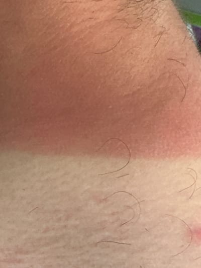 The image shows a close-up view of human skin, likely an arm or leg, exhibiting a distinct line of sunburn. The left side of the image displays skin that is significantly reddened, indicating a sunburn. The right side shows skin that is less affected by the sun, appearing lighter in tone. The boundary between the sunburnt and less-sunburnt areas is a clear, sharp line, suggesting that something was covering this part of the skin, preventing it from being exposed to the sun.

Visible on both areas of skin are scattered dark hairs, which are more numerous on the left side of the image. The texture of the skin is visible, with pores and some natural variations in its surface. There are no objects or discernible background elements other than the skin itself. The lighting appears to be from a direct source, casting subtle shadows and highlighting the texture of the skin. There is no visible text in the image. The context of Moortown, Ireland, suggests this could be an outdoor exposure event, possibly during a rare period of strong sunlight. The reddening of the skin is a clear sign of an activity involving sun exposure.