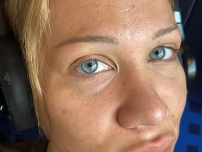 This is a close-up, eye-level, medium shot, taken outdoors, of a woman's face, with a particular focus on her eyes and nose. Her fair skin shows visible pores and some mild blemishes. She has blonde hair, and appears to be wearing headphones over her left ear. Her eyes are blue and are looking directly at the camera. The lighting is bright and appears to be natural sunlight. The background is out of focus, but suggests an urban or transportation environment with blue elements. The location is Ampfing, Germany.