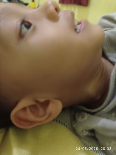 A close-up, low-angle shot shows a child's face, turned to the right and looking upwards. The child is lying down, with their head resting on a yellow surface. They are wearing a light gray shirt with a subtle pattern. The child's left eye is partially visible, and their mouth is slightly open, revealing a glimpse of their teeth and gums. The lighting suggests it is indoors. A timestamp in the bottom right corner reads "24/06/2026 20:33". The scene is set in Sukaraja, Indonesia.