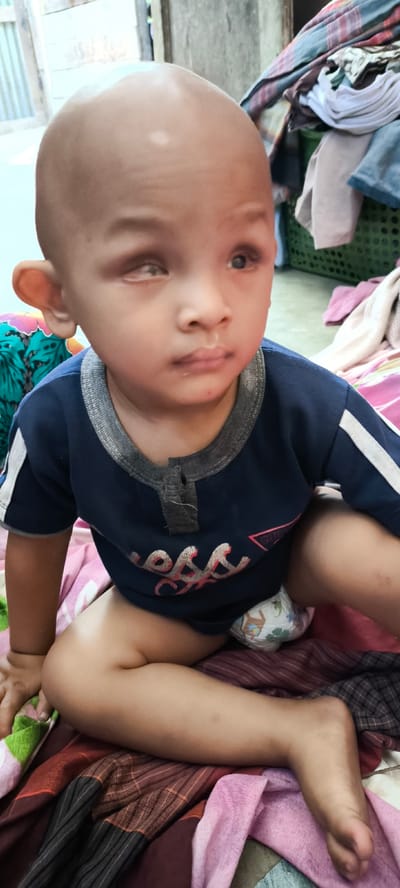 A young child, likely a toddler, sits on a patterned blanket. The child has a shaved head with a light spot on the crown, and is looking to the right of the frame. The child's right eye appears to be directed forward, while the left eye is looking upward and to the left. The child is wearing a dark blue t-shirt with white stripes on the sleeves and a grey neckline. A diaper is visible. The background shows a pile of folded laundry in a green basket and what appears to be a wooden structure. The scene is likely indoors, possibly in a home, in Blangseureukuy, Indonesia.