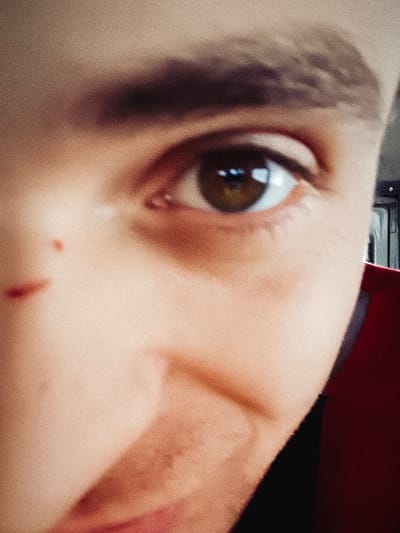 A close-up shot focuses on a person's face, dominated by their right eye with a visible brown iris and distinct eyebrow. A mole is present on the cheekbone near the nose. The skin is fair with a slight reddish tint. A red object is visible on the right side.
