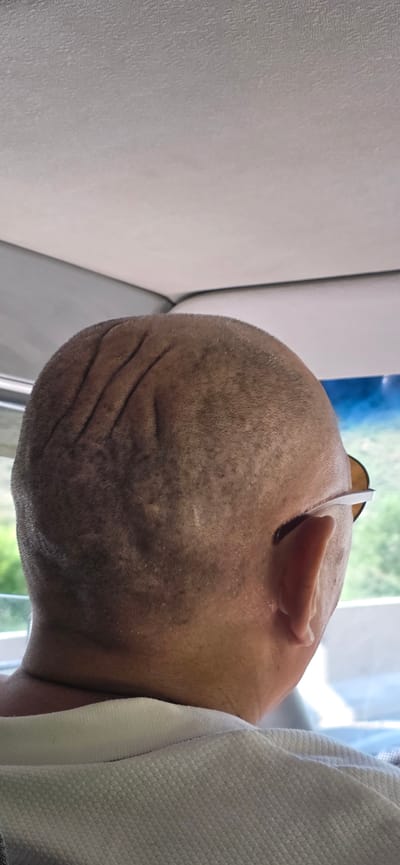 A close-up, rear-view shot shows the back of a person's head and neck, wearing a white shirt. The person has a closely shaved head with visible indentations or scars on the scalp. The person is also wearing sunglasses. The background suggests an indoor environment, possibly a vehicle, with a view of greenery and sky through a window. The image does not contain any information that would allow for identification of the location in Krasnyy Most, Kyrgyzstan.