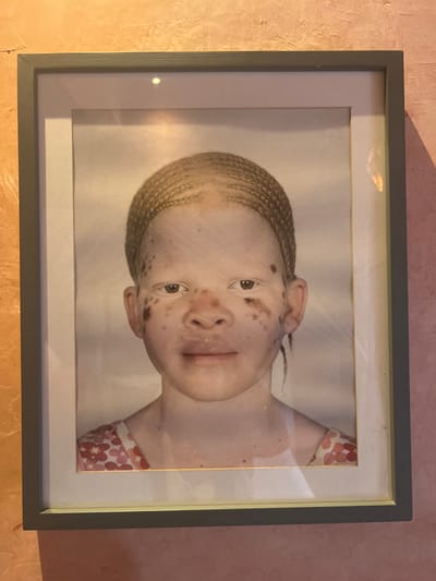 A framed portrait of a young person with albinism hangs on a wall. The individual has fair skin, light blonde braided hair, and brown spots across their face. They are wearing a pink and white floral-patterned top. The frame surrounding the portrait is a muted gray color. The wall behind the artwork is textured and appears to be painted in a warm, slightly faded tone.