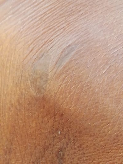 The image shows a close-up of human skin. The skin is tan, displaying fine wrinkles and lines. A noticeable discoloration, appearing as a bruise or scar, is present with slightly lighter shade. The texture is detailed, highlighting the natural ridges and patterns of the skin. A small, light-colored spot is also visible. The overall impression is of aged and textured skin.