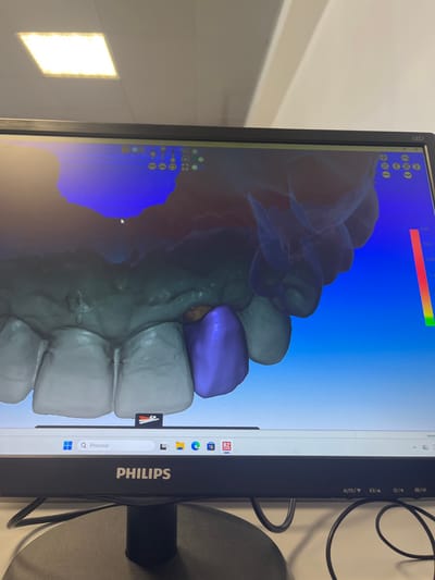 An indoor scene in Gandra, Portugal, focuses on a black Philips computer monitor displaying a 3D dental CAD software interface. The screen exhibits a digital model of a patient's lower dentition, rendered in light grey, with one molar on the lower right quadrant highlighted in purple, indicating a prosthetic design (likely a crown). Above this, a transparent blue digital model of the opposing arch or a scan is visible. User interface icons for various tools are displayed at the top edge of the software window, and a vertical color gradient scale (red to green) is positioned on the right. The Windows taskbar is visible at the bottom of the monitor, featuring a search bar labeled "Procurar" (Portuguese for "Search"), and icons including Microsoft Edge. The monitor's bezel shows "PHILIPS" centrally and "LED" on the upper right. Black cables are visible on a light-colored surface beneath the monitor. An illuminated rectangular fluorescent light fixture is reflected on the monitor screen and is part of the overhead ceiling structure. No individuals are present in the image.