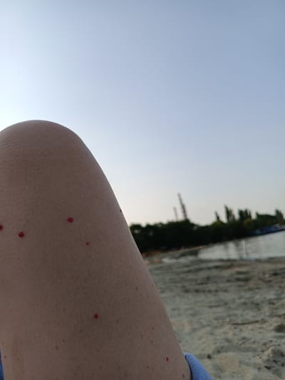The image is a close-up of a person's leg with several small red spots on the skin. The leg is angled towards the right side of the frame. In the background, out of focus, is a beach with sand, water, and trees along the shoreline. Industrial structures and clear sky are also visible in the distance. The lighting suggests it is either early morning or late afternoon. The location is identified as Nezavertaylovka, Moldova.