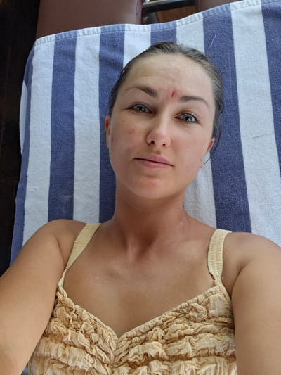 A woman lies on a blue and white striped towel. The towel appears to be placed on a dark brown surface. She is wearing a beige top with a ruffled design. She has fair skin, blue eyes, and a small scrape on her forehead. The image was likely taken in Lodtunduh, Indonesia.
